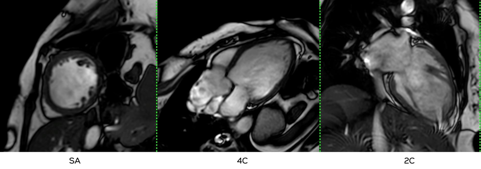 Case 131: When the Dilatation is Mechanical