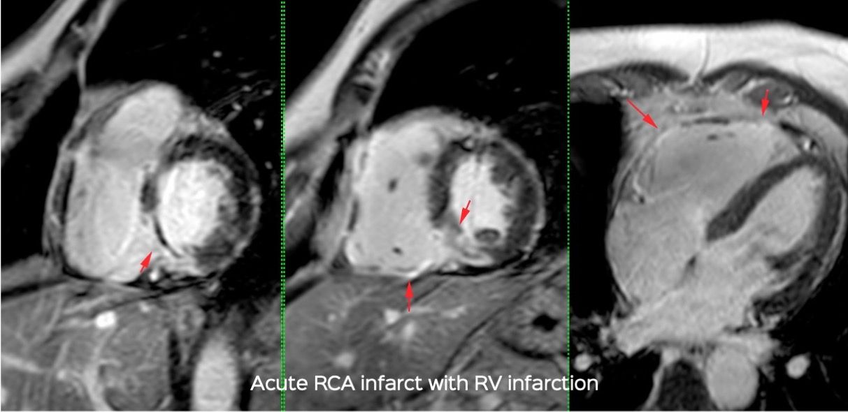 Case 10 - 60-Years Old Man with an Acute RCA Territory Infarct and the Importance of Evaluating the RV