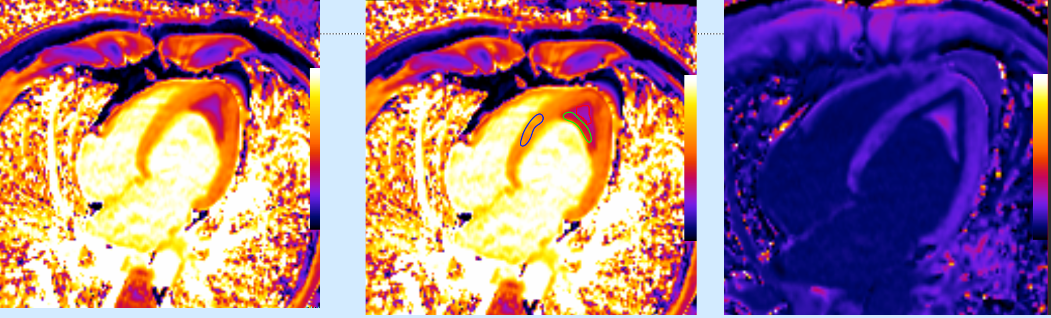 Loeffler's Endocarditis