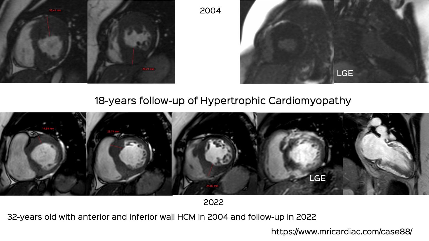 Case 88: Hypertrophic Cardiomyopathy – 18 Years CMR Follow-Up