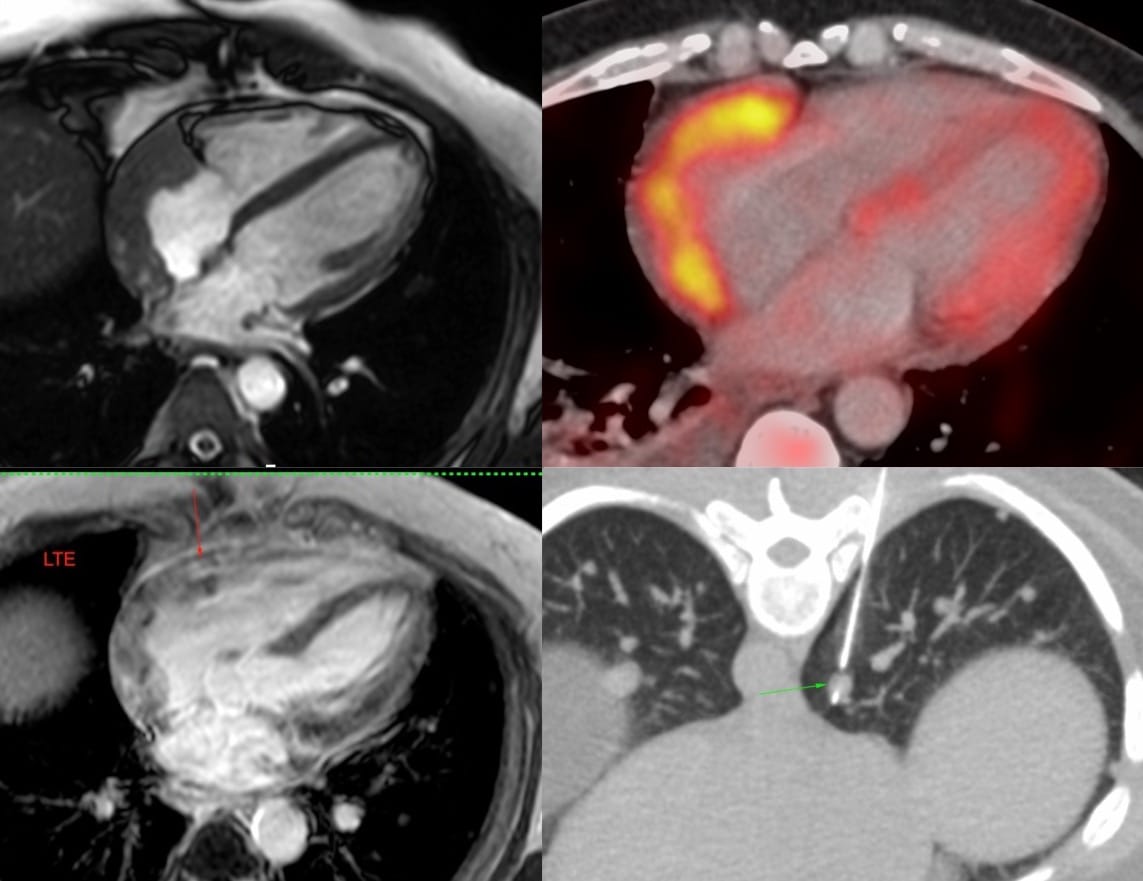 Case 5: 47-Years Old with a Right Atrial Mass and Lung Nodules