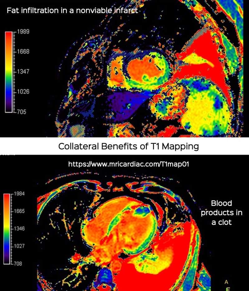 The Collateral Benefits of T1 Mapping