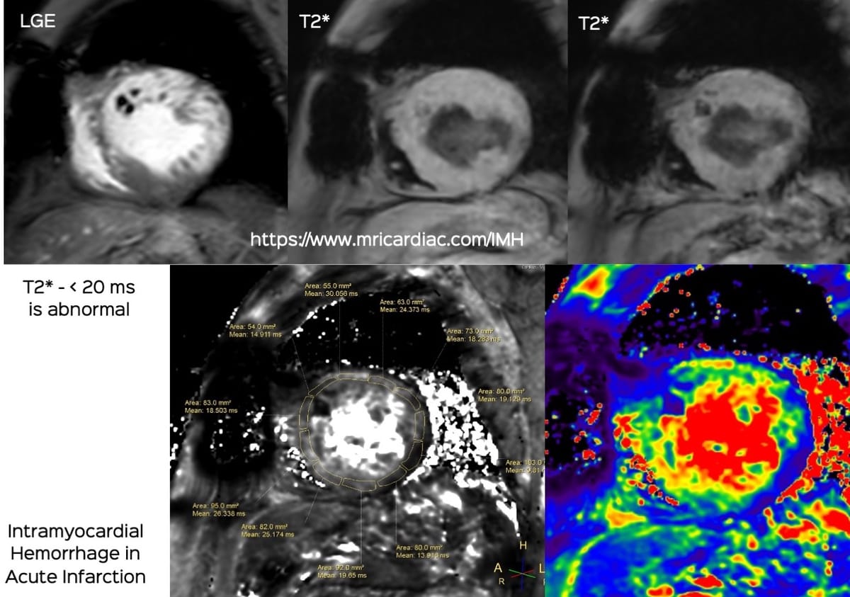 Intramyocardial Hemorrhage in Acute Infarction