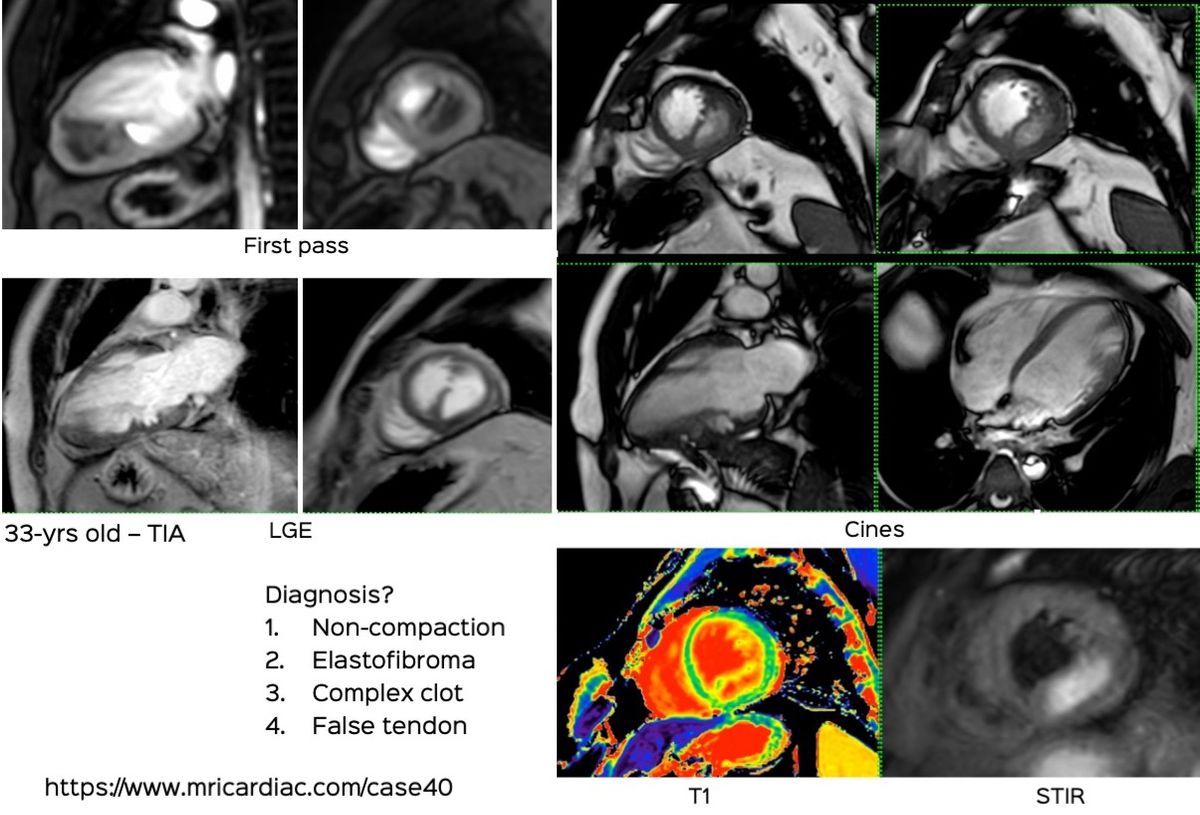 An Unusual Double-Chambered Left Ventricle