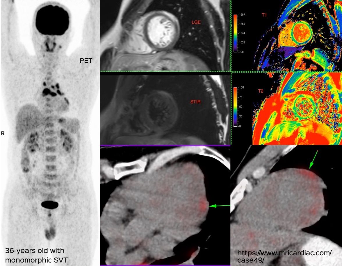 Combined Studies for Granulomatous Cardiomyopathy