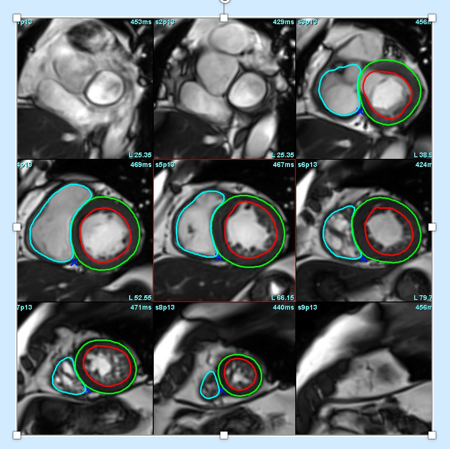 How to do? LV/RV function with CMR