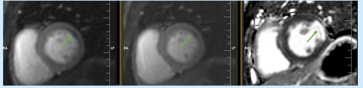 How to do? Stress perfusion CMR