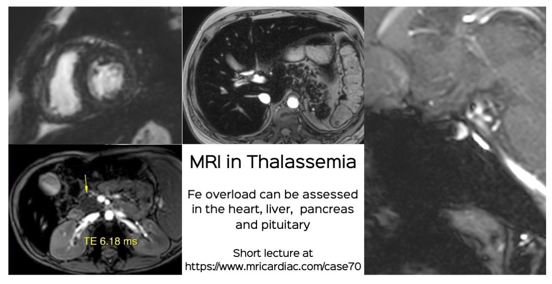 Short Lecture: MRI in Thalassemia