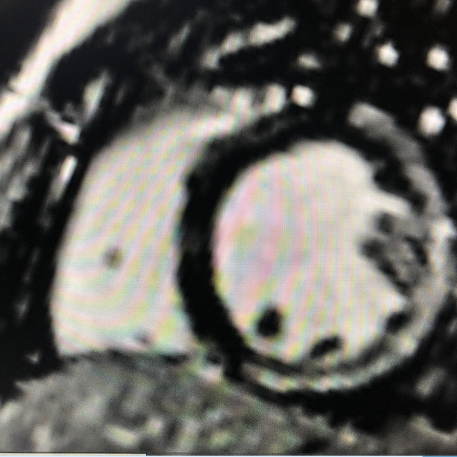 CMR in muscular dystrophy