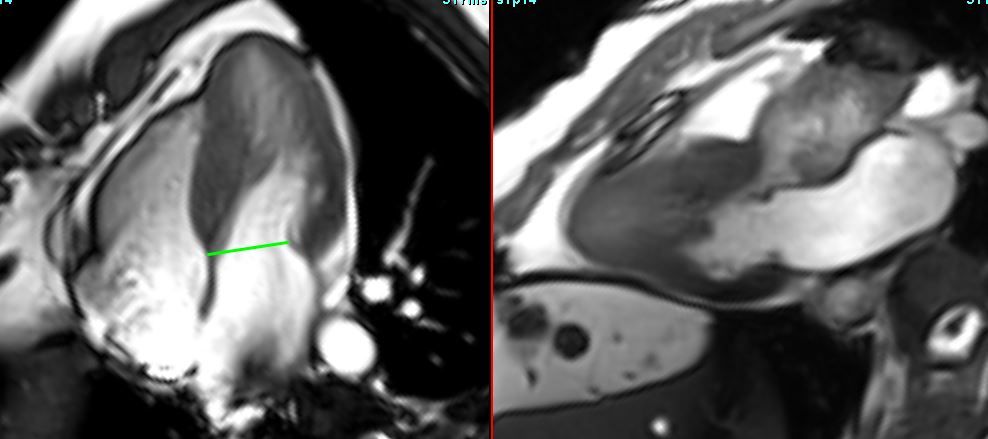 HCM with LVOT obstruction