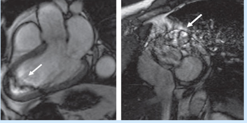 Common CMR artifacts