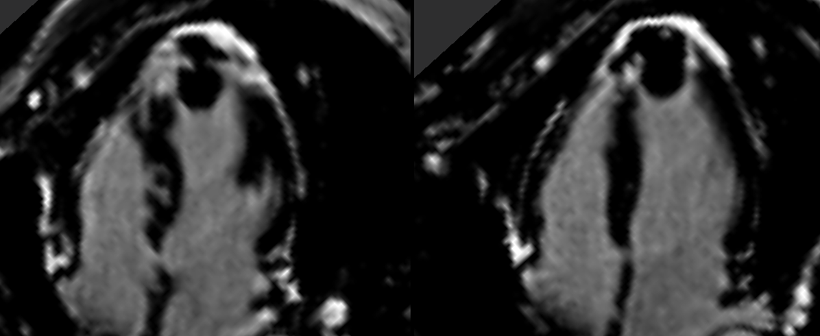 Thrombus or hematoma?