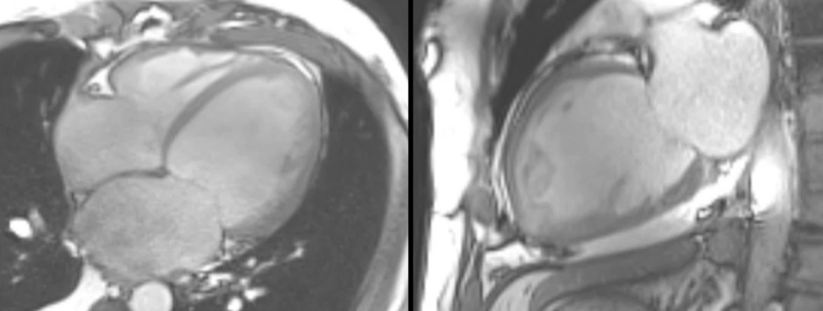 101: Genetic basis of DCM