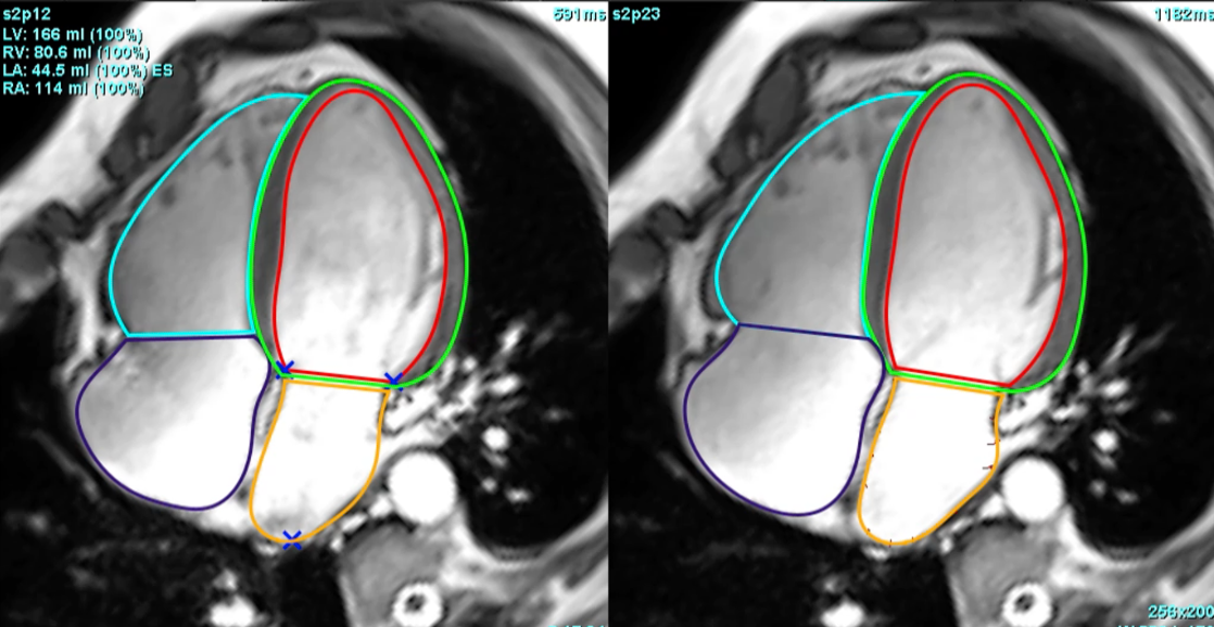 Left atrial dysfunction