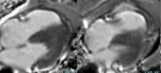 Isolated RV infarction.