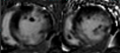 Embolic microinfarcts