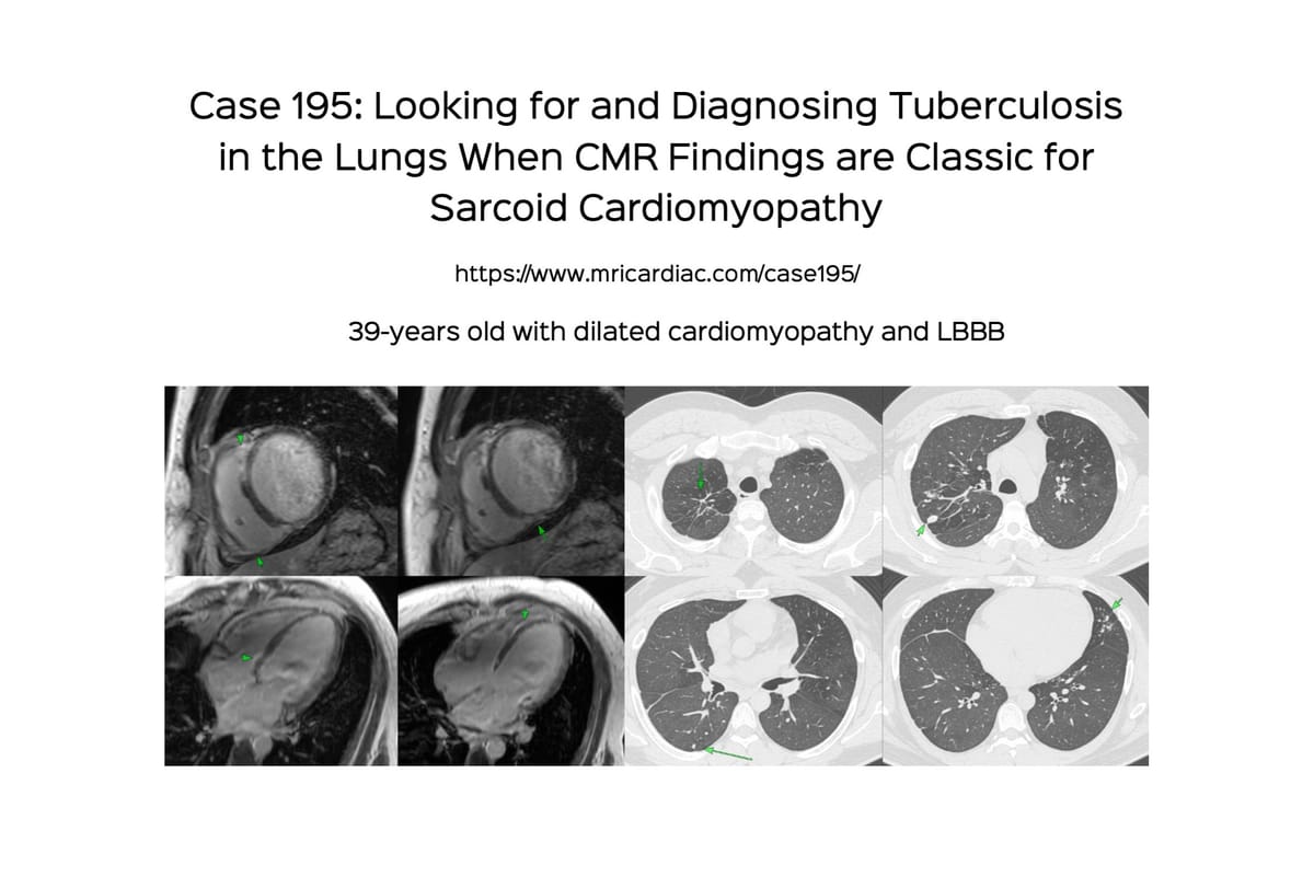 Case 195: Looking for and Diagnosing Tuberculosis in the Lungs When CMR Findings are Classic for Sarcoid Cardiomyopathy