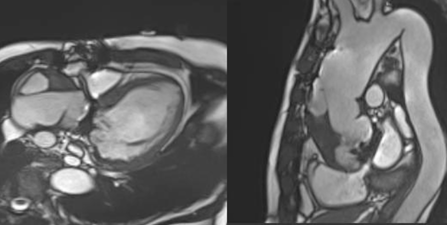 No problem with prosthetic valve!
