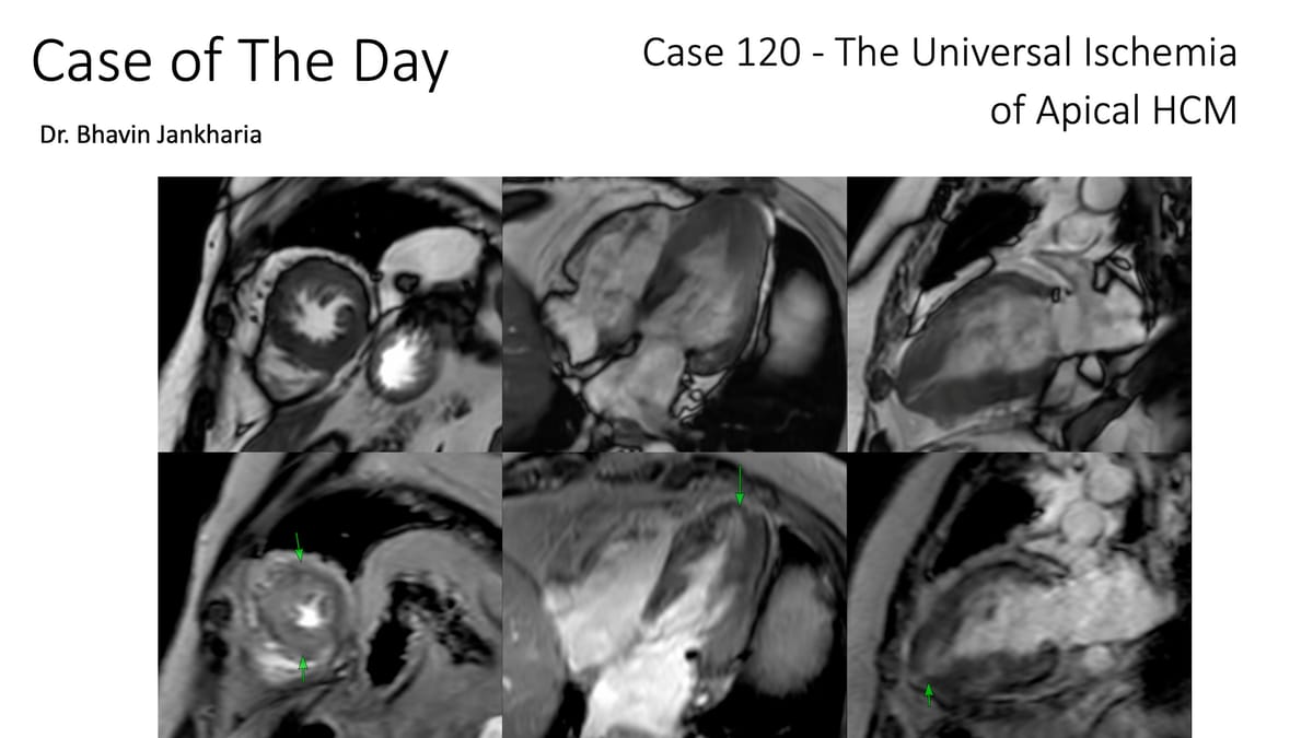 Case of the Day 120 - The Universal Ischemia of Apical HCM