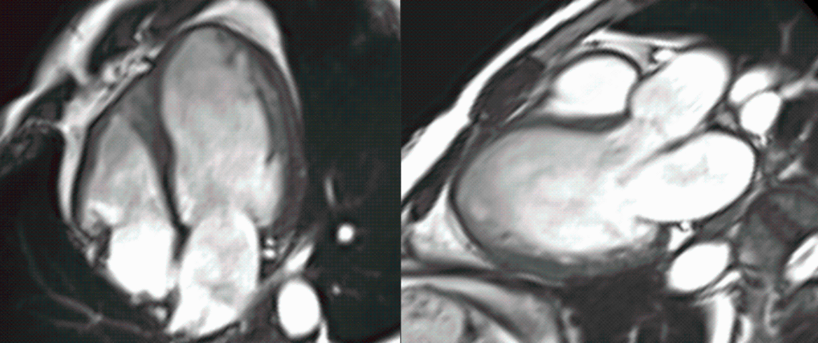 Conundrum of Ischemic DCM
