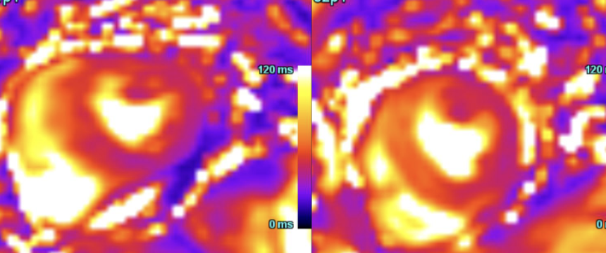 MI classification revisited