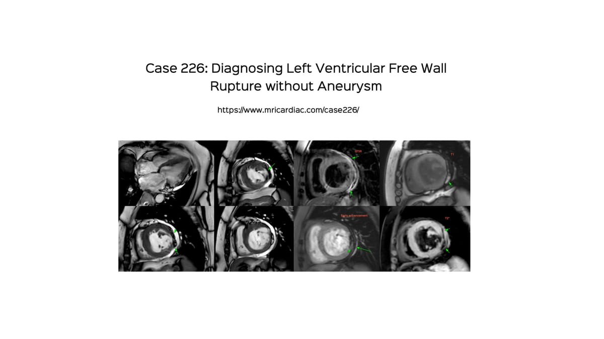 Case 226: Diagnosing Left Ventricular Free Wall Rupture without Aneurysm
