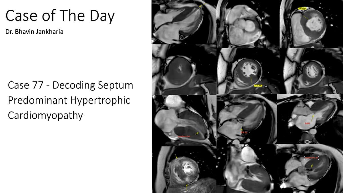 COD 077 - Decoding Septum Predominant Hypertrophic Cardiomyopathy