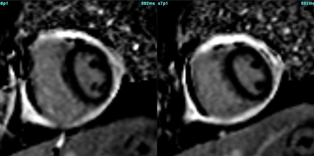 Thick shell around heart!