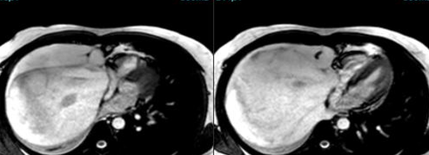 The Heart Under Siege !