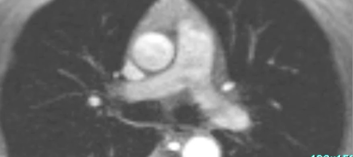 Phase contrast CMR