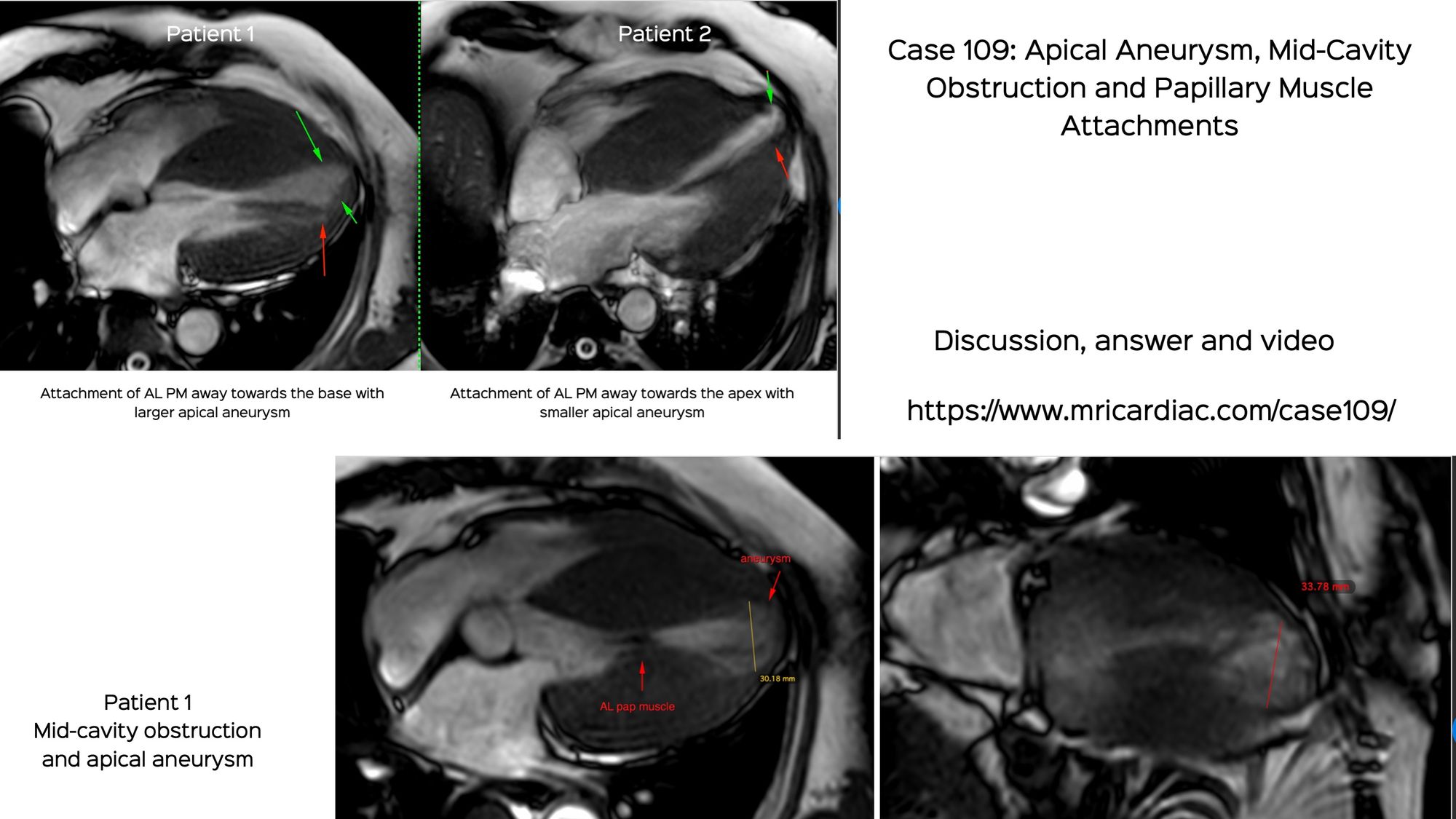 Case 109: Apical Aneurysm, Mid-Cavity Obstruction and Papillary Muscle Attachments