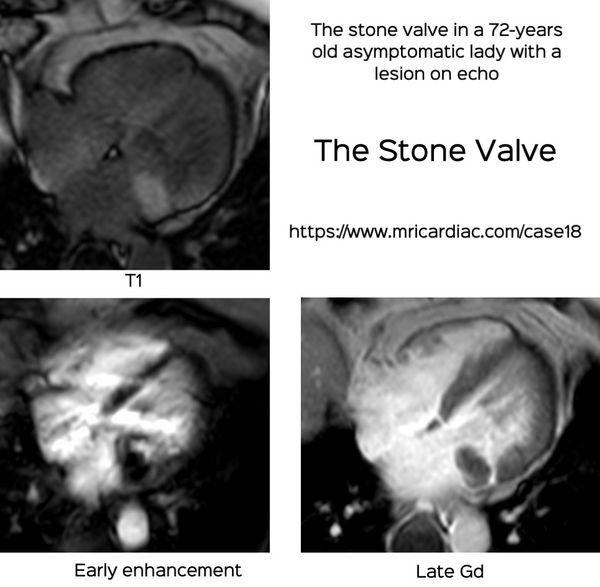 The Stone Valve