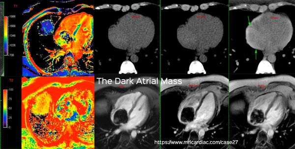 The Dark Atrial Mass