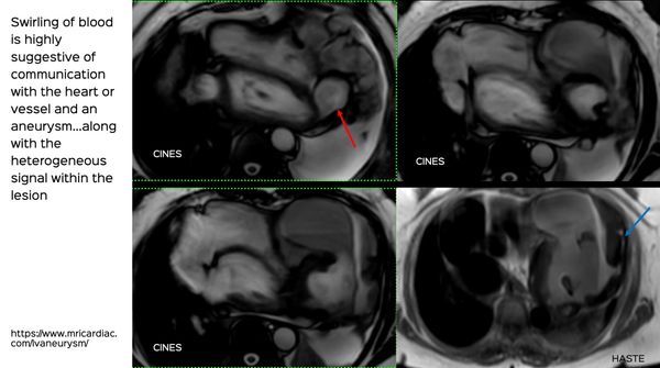 Multimodality Imaging of an LV Aneurysm