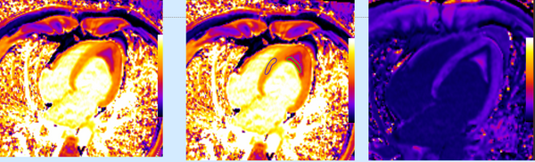 Loeffler's Endocarditis