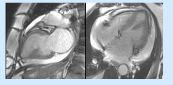 Drug-induced cardiotoxicity