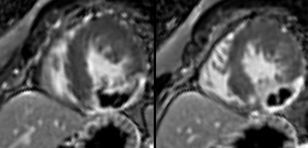 HCM or MINOCA?