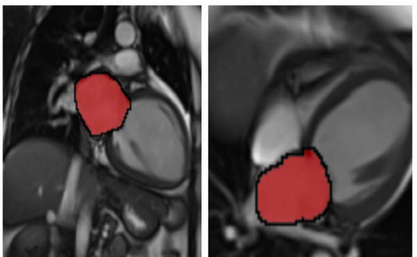 Left atrium assessment