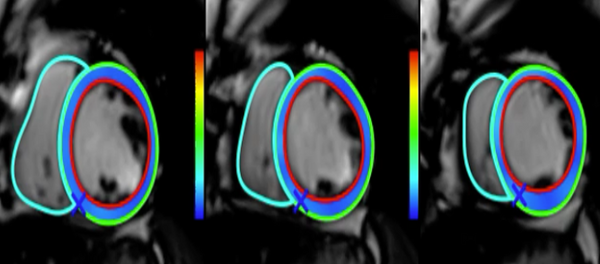 CMR strain assessment