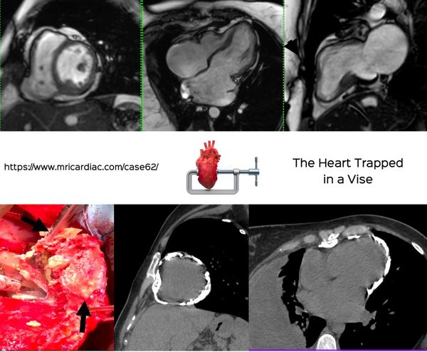 The Heart Trapped in a Vise