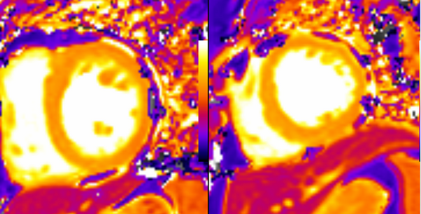 Heart failure with preserved EF