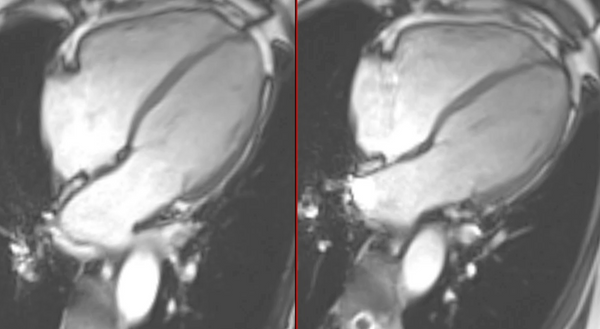 Atrial myopathy