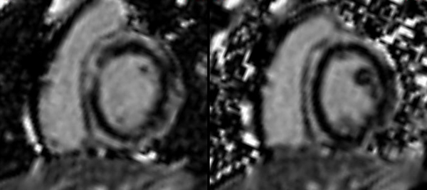 Myocarditis or Cardiomyopathy?