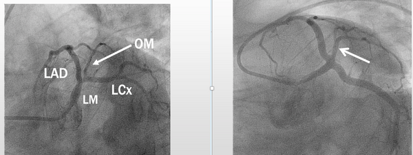 Basics of Cath angiography