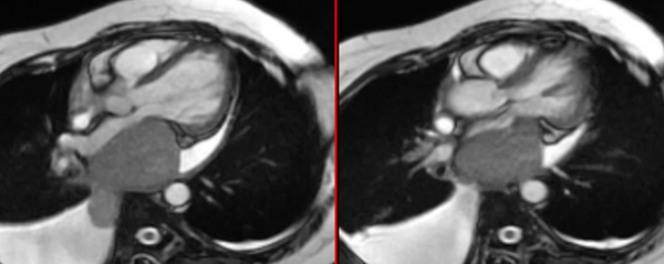 Rare extracardiac mass