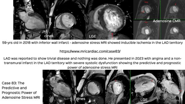 Case 83: The Predictive and Prognostic Power of Adenosine Stress Perfusion CMR