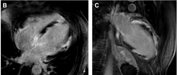 Phenotypes of cardiac sarcoidosis: