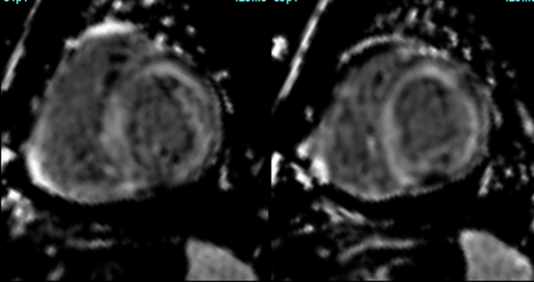 Cardiac amyloidosis