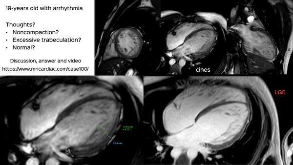 Case 100: What’s in a Name? Excessive Trabeculation? Noncompaction? Does it Matter?