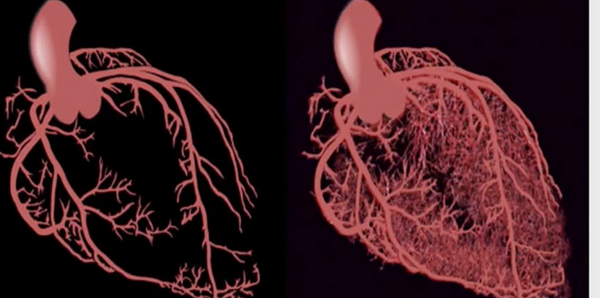 Microvascular dysfunction